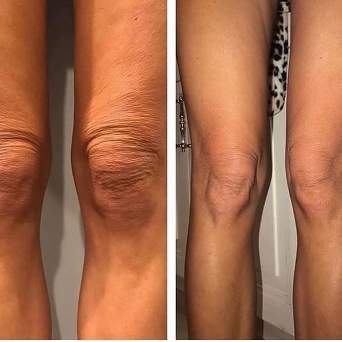 Cryotherapy 1 ponte vedra beach cryotoning