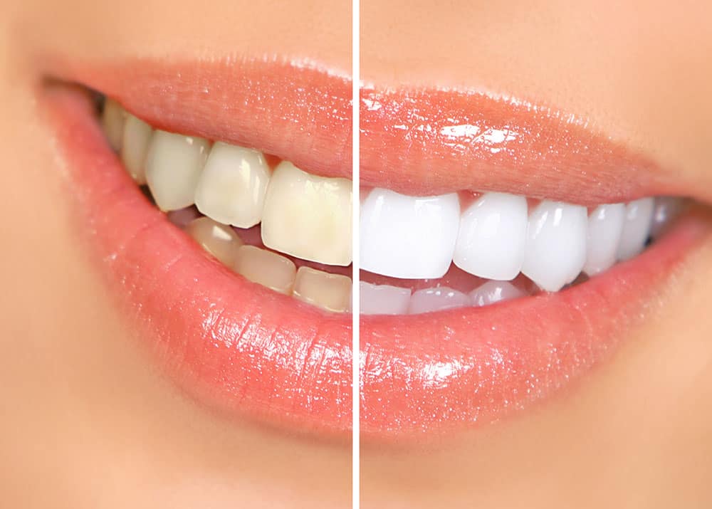 Teeth Whitening 1 Teeth Whitening Services Ponte Vedra Beach, FL